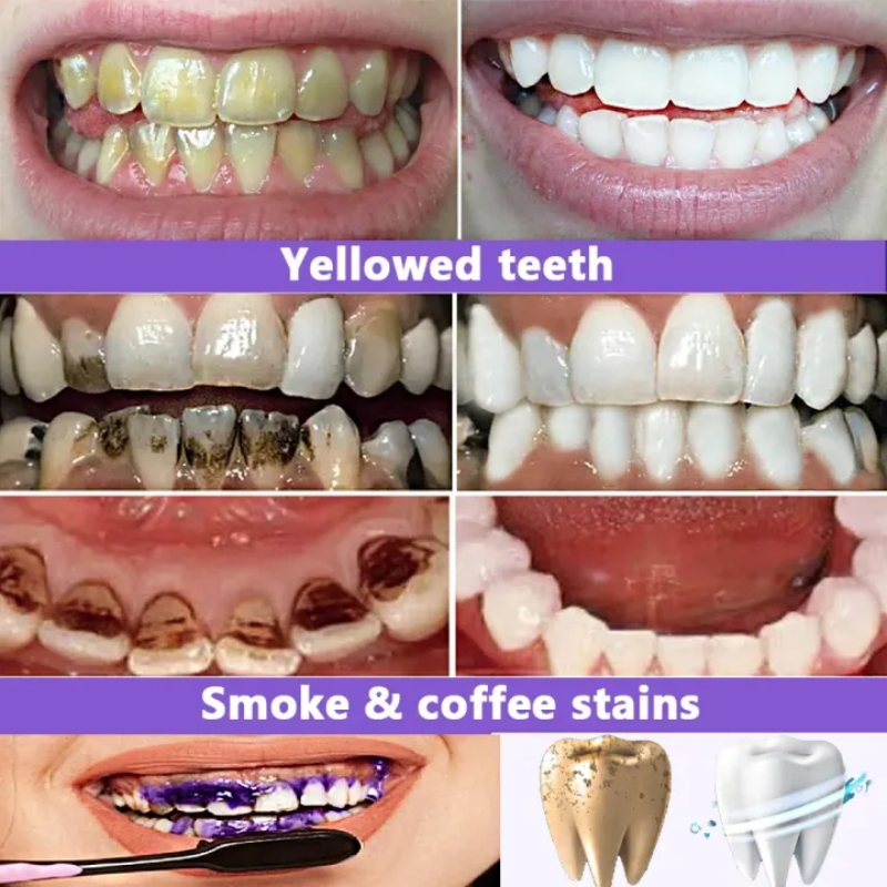 Bestverkochte whitening tandpa - Teeth Whitening Effective recensie en prijs