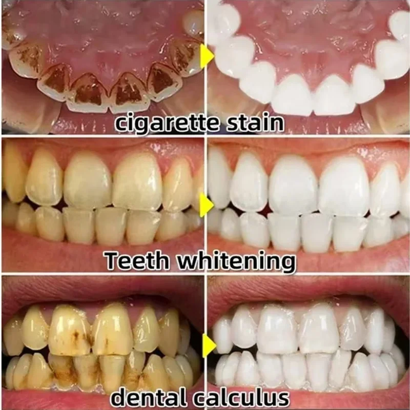 Snel Reparatie Tandvlees Serum - Teeth Whitening Baking Soda recensie en prijs