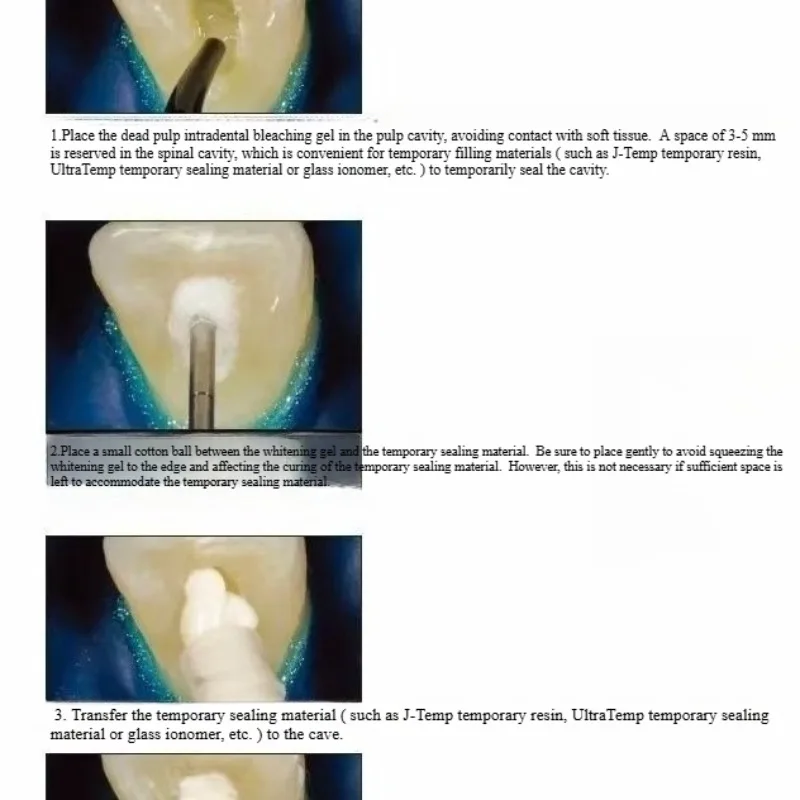 Tandheelkundige Orale Restaura - Teeth Whitening Effects recensie en prijs