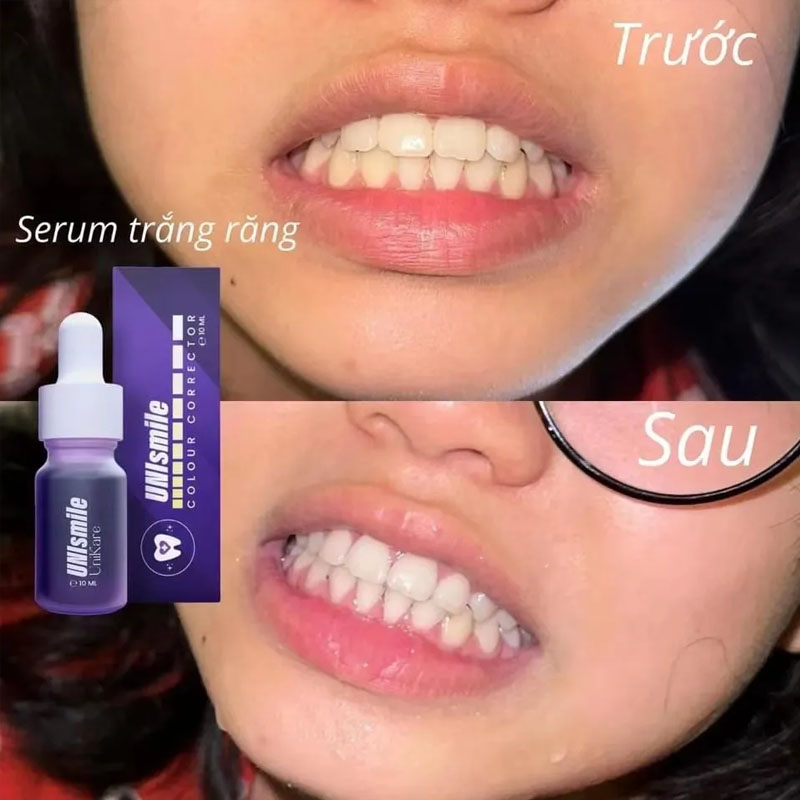 Unismile Teeth Whitening Essen - Teeth Whitening Effective recensie en prijs