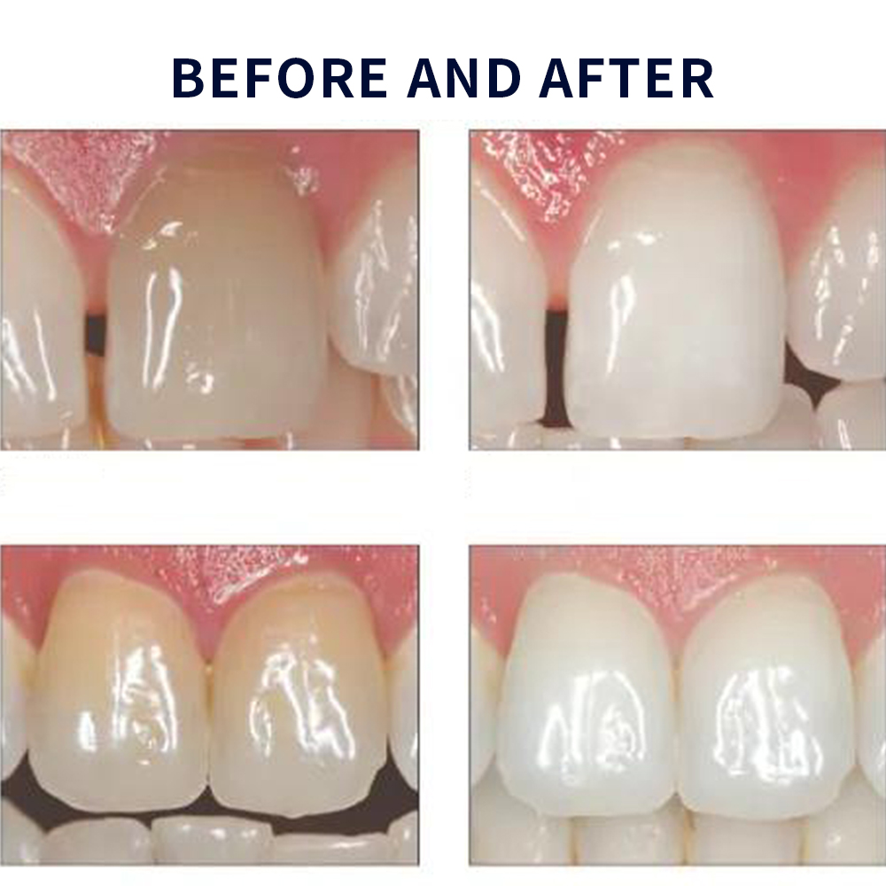 Opalescentie Whitening 20% Pf  - Teeth Whitening Foam recensie en prijs