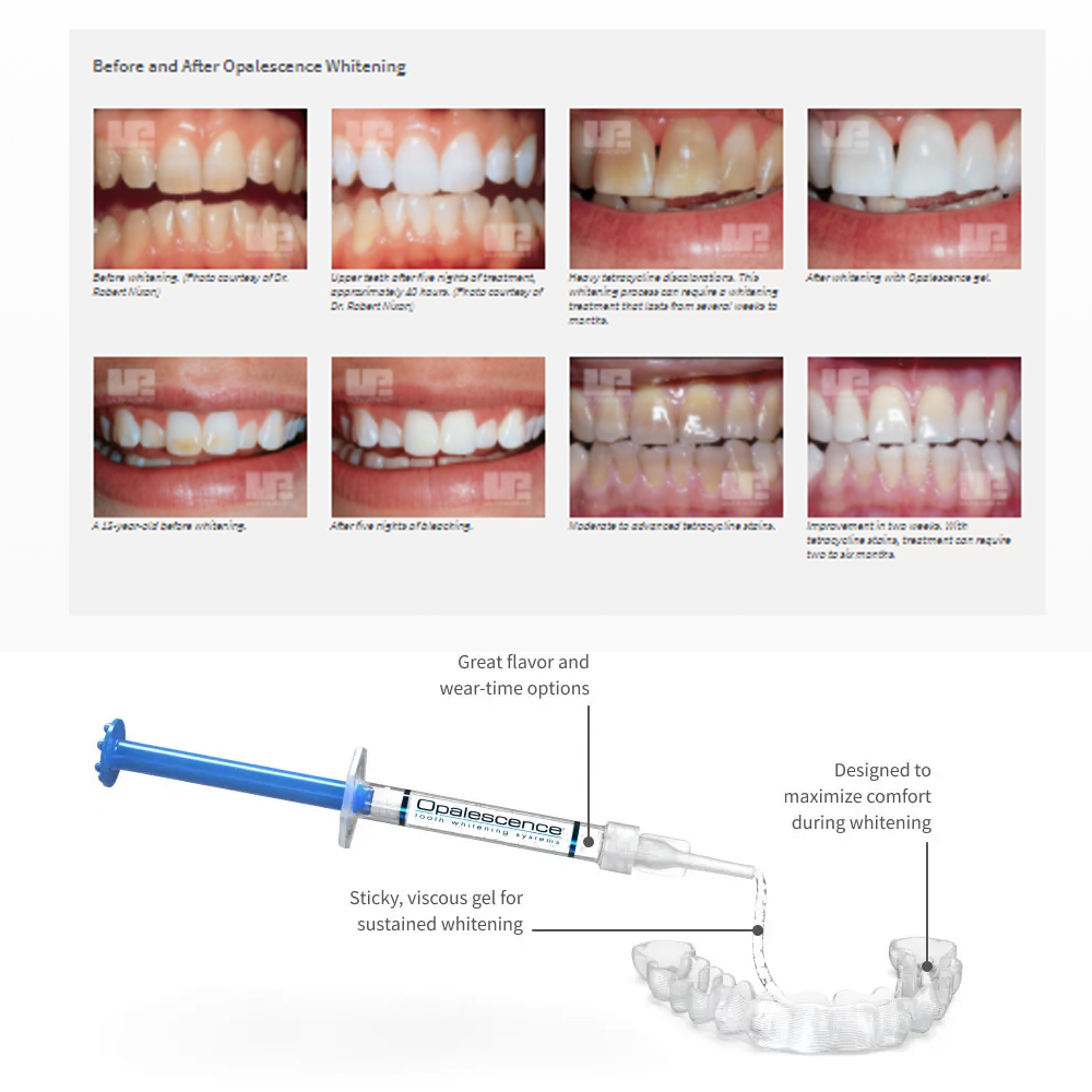 Opalescentie Whitening 20% Pf  - Teeth Whitening Foam recensie en prijs