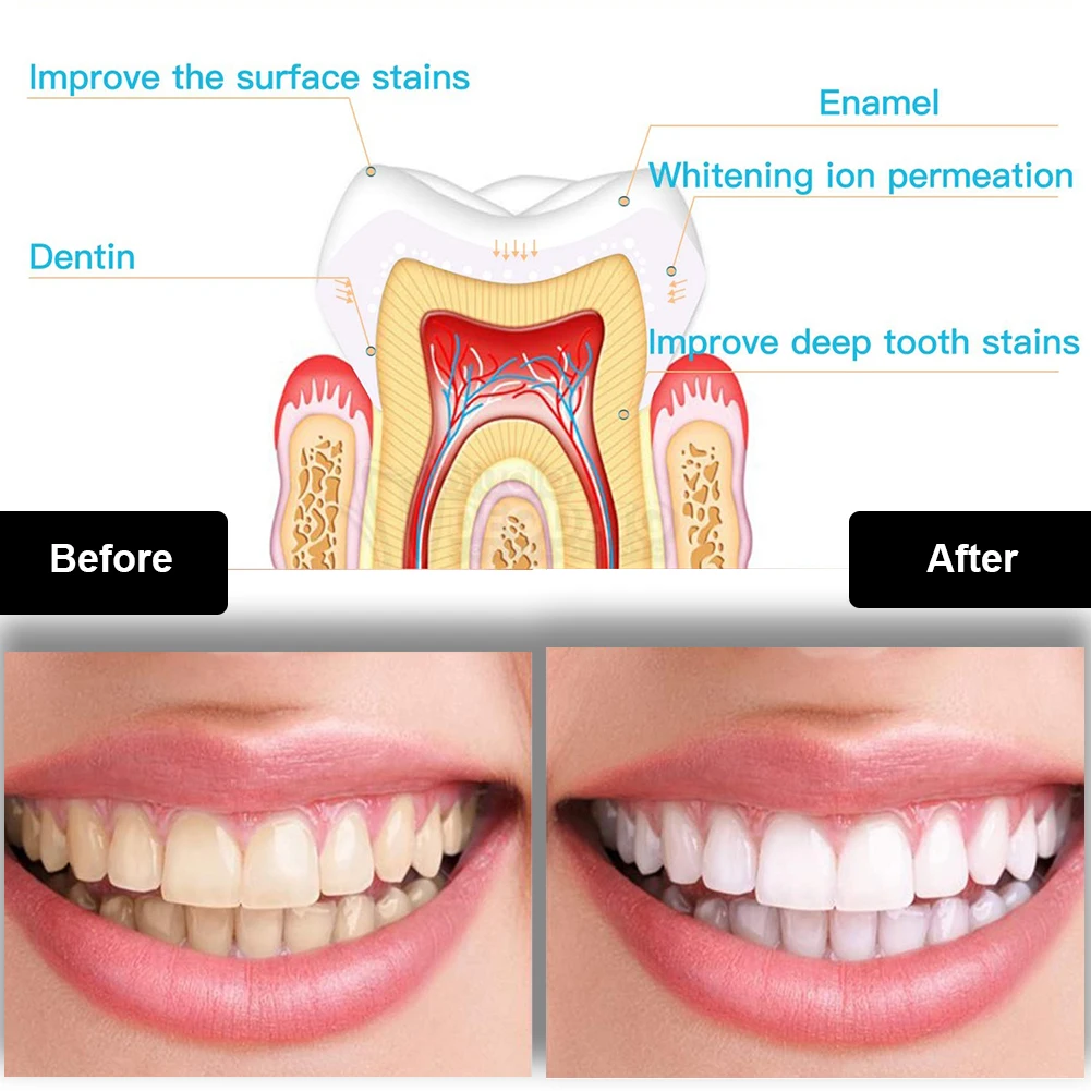 Tandheelkundige Tanden Whiteni - Teeth Whitening Foam recensie en prijs