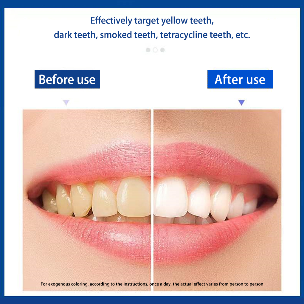 70/140 Paar 5d Witte Tanden Wh - Teeth Whitening Effects recensie en prijs